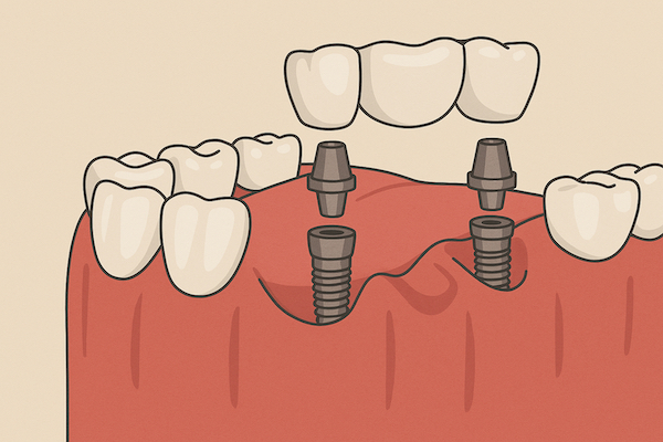 Puentes dentales: Qué son, tipos y cuándo se recomiendan